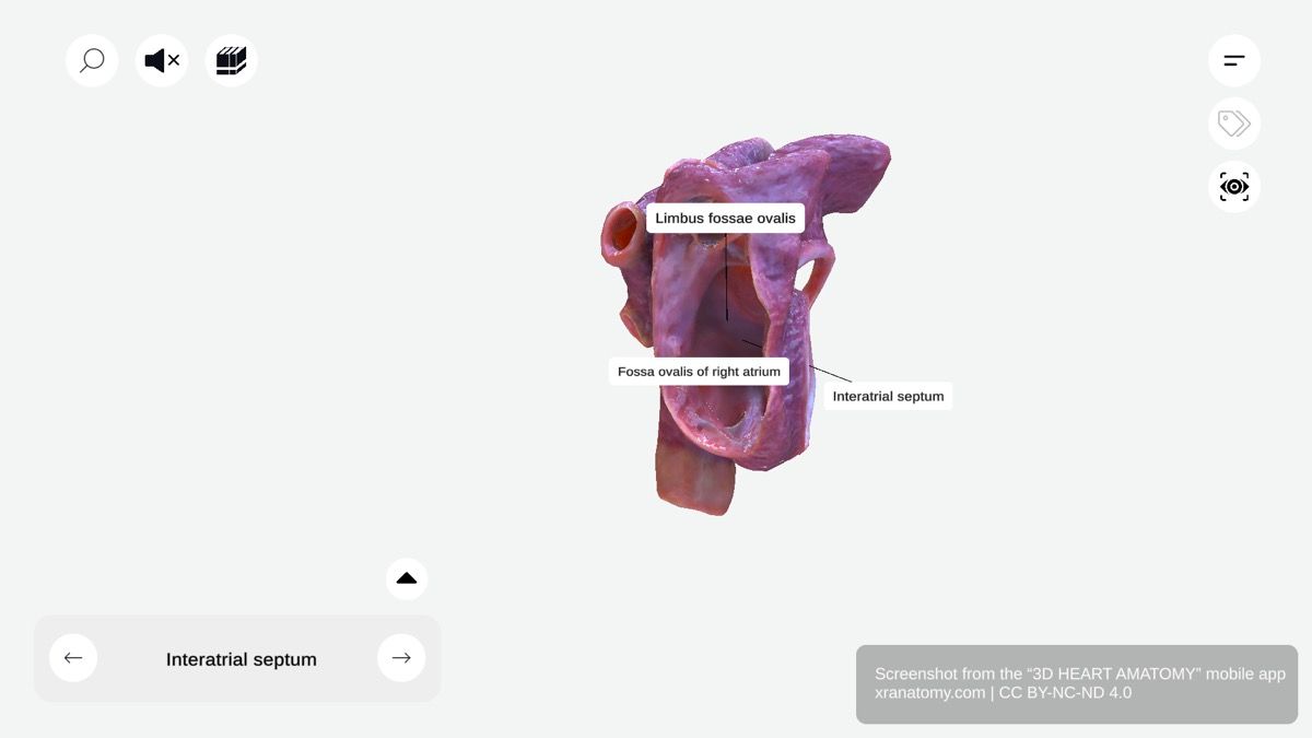 Interatrial septum 360-degree viewer showing thin wall between right and left atria with fossa ovalis and limbus fossae ovalis