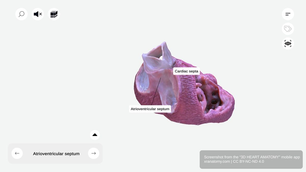 Atrioventricular septum 360-degree viewer showing portion of septum between atria and ventricles with offset valve attachment