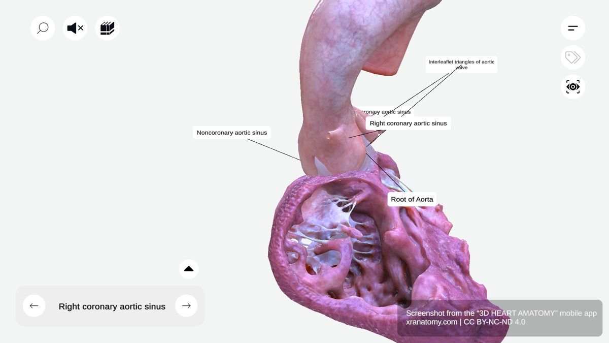 Aortic sinuses 360-degree interactive viewer showing sinuses of Valsalva above aortic valve leaflets