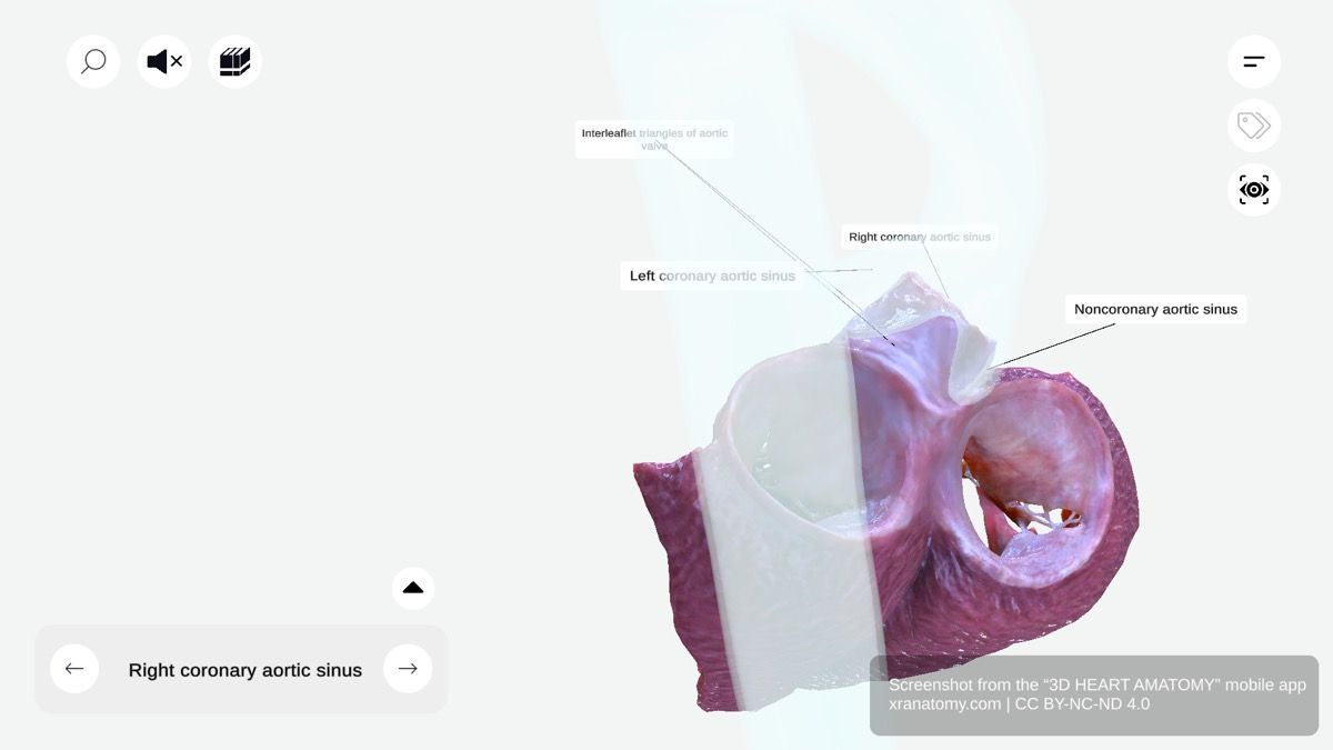 Interleaflet triangles 360-degree interactive viewer showing fibrous structures between aortic valve leaflet attachments