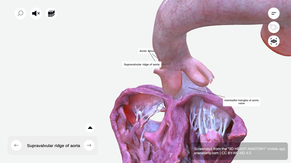 Supravalvular ridge 360-degree interactive viewer showing fibrous ring at junction of aortic root and ascending aorta