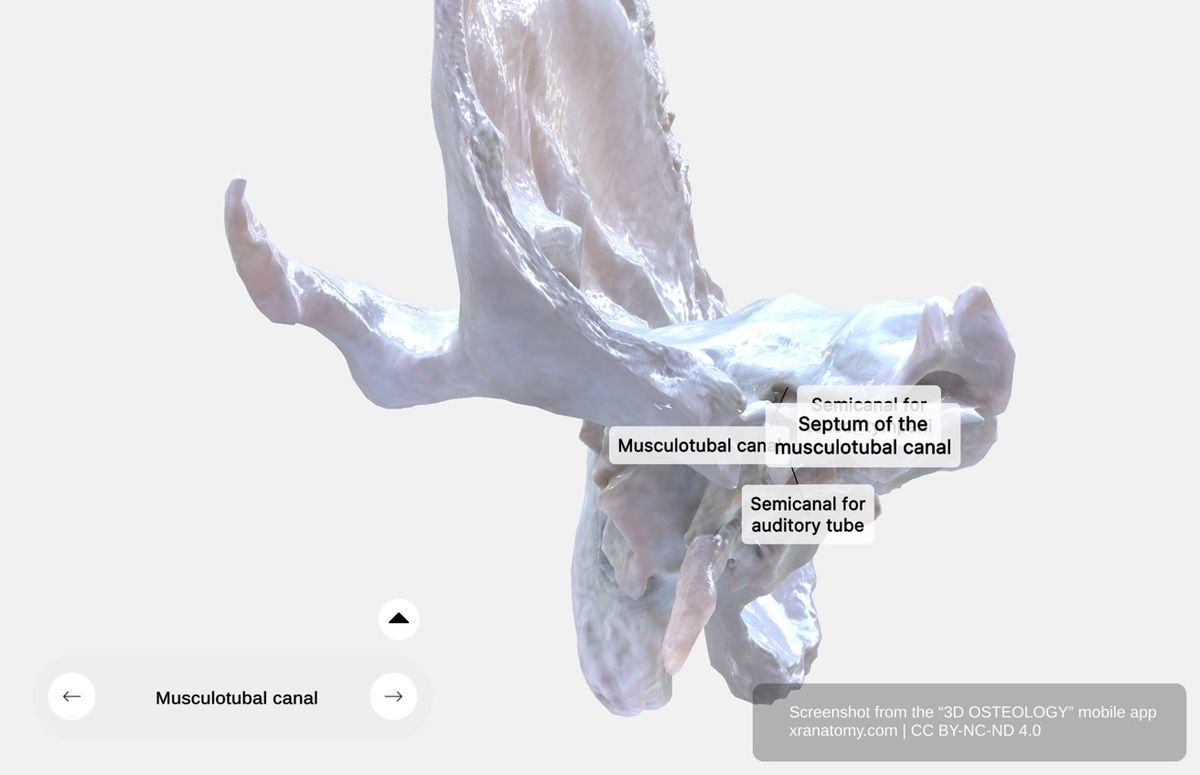 Musculotubal canal 360-degree viewer showing tensor tympani semicanal and auditory tube semicanal separated by bony septum