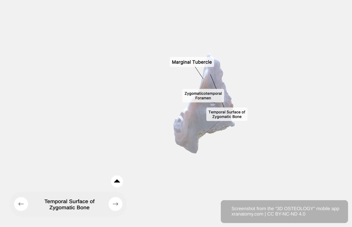 Zygomatic bone temporal surface 360-degree viewer showing concave inner aspect, zygomaticotemporal foramen, marginal tubercle, and temporal fossa contribution