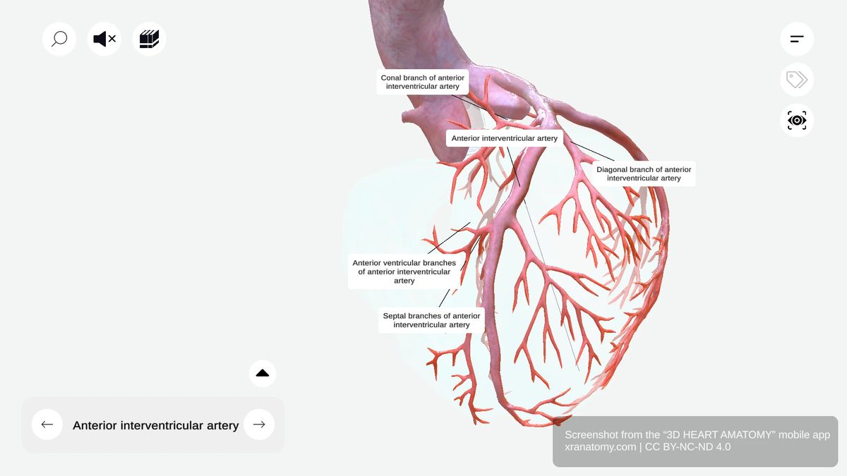 Branches of anterior interventricular artery showing conal branch, anterior ventricular branches, diagonal branch, and septal branches