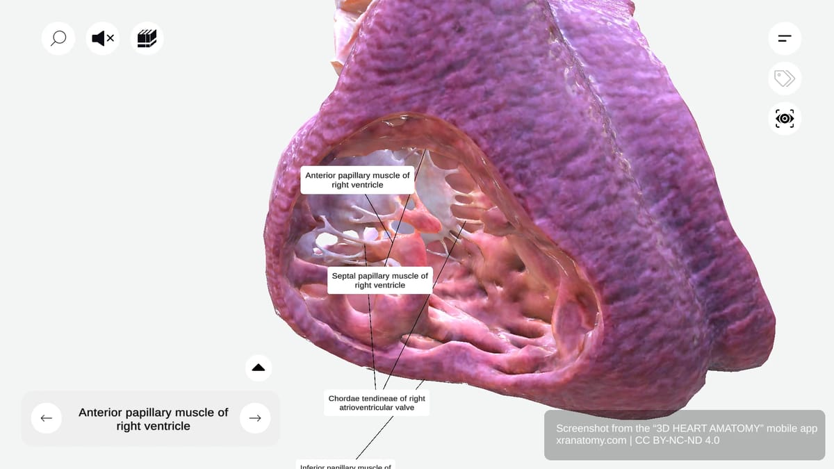 Chordae tendineae of right ventricle showing fibrous cords connecting papillary muscles to tricuspid valve leaflets