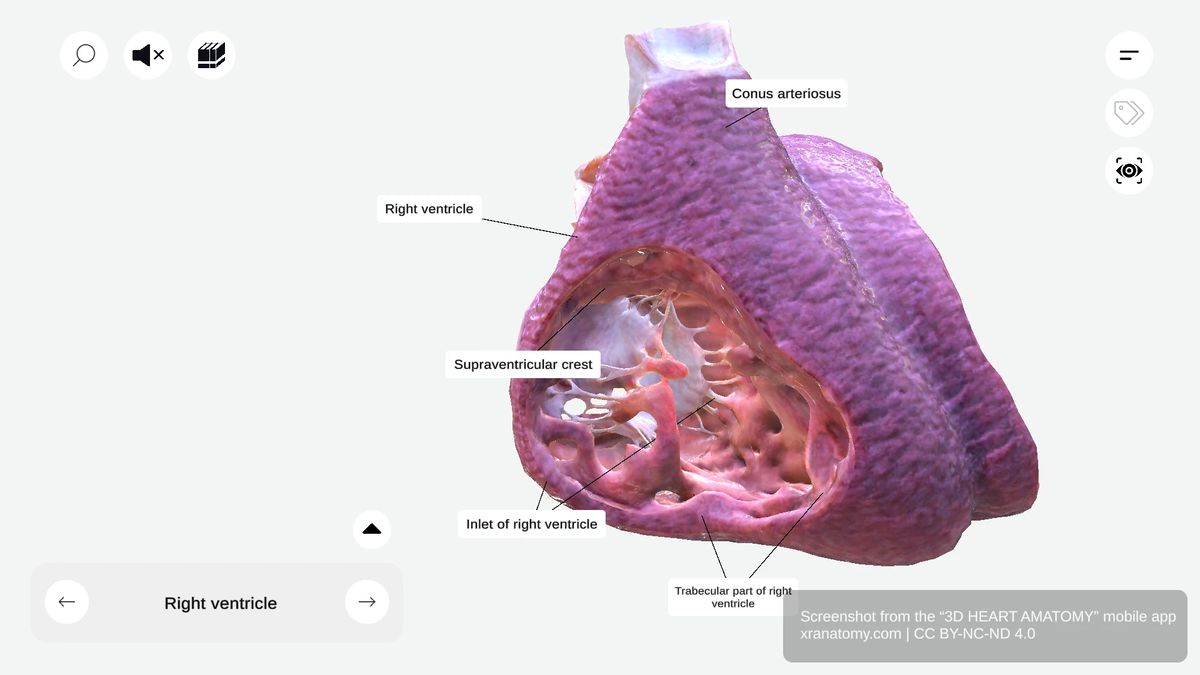 Inlet of right ventricle showing tricuspid valve apparatus with leaflets, chordae tendineae, and papillary muscles