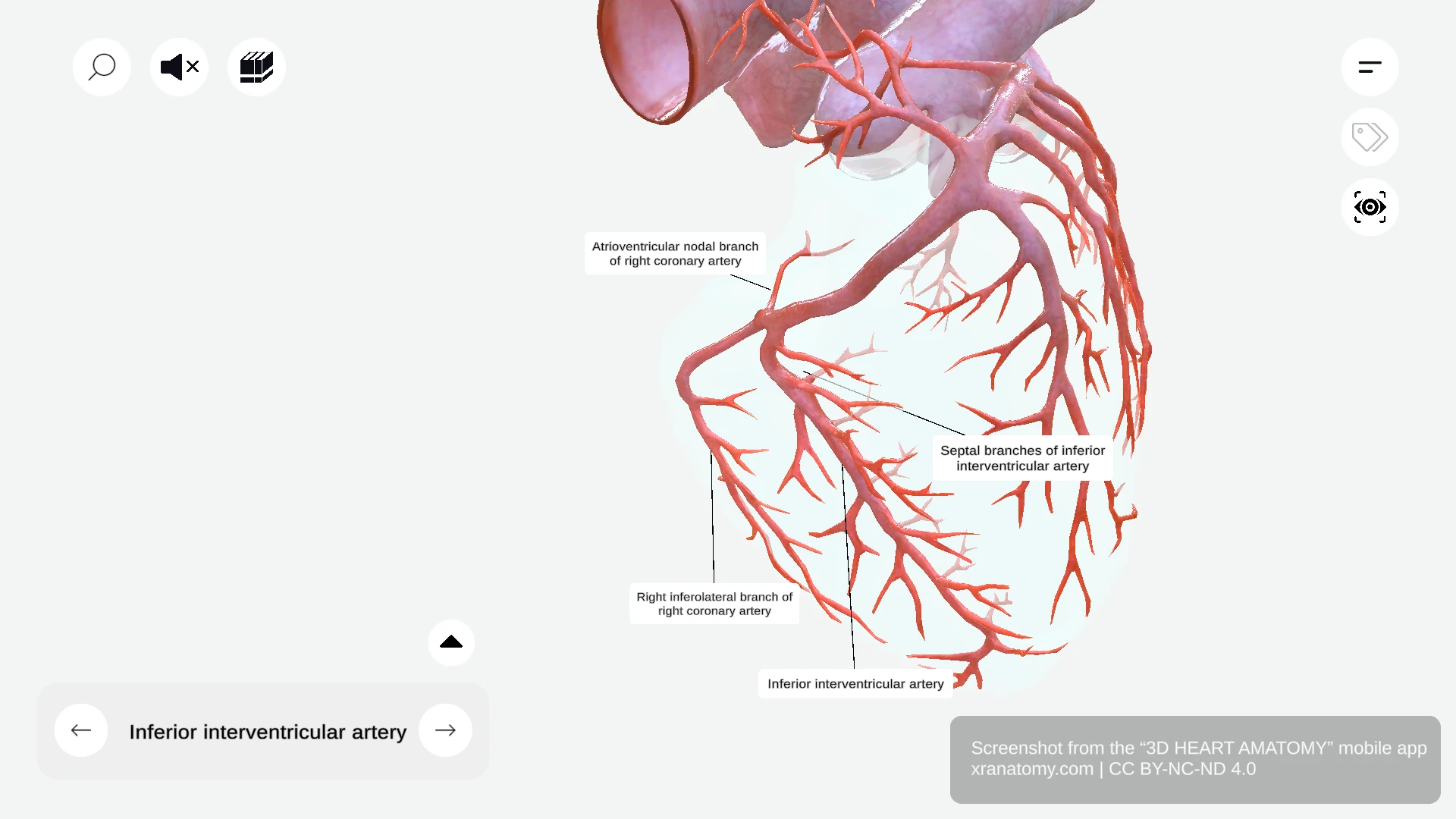 Inferior interventricular artery (posterior descending artery) running along inferior interventricular groove with septal branches