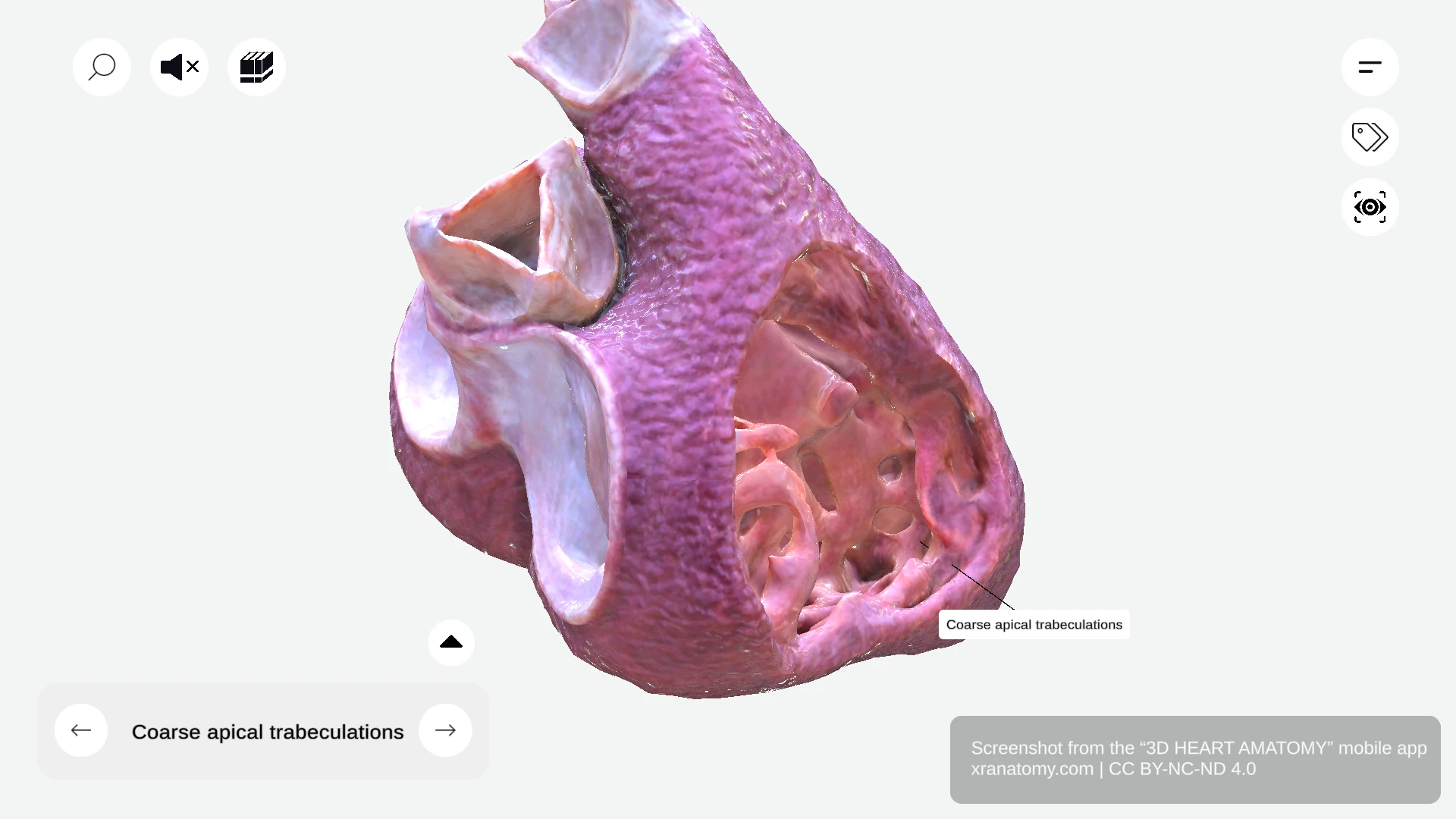 Coarse apical trabeculations of right ventricle showing robust muscle bundles at ventricular apex